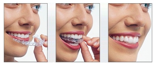 Изготовление индивидуальных зубных кап